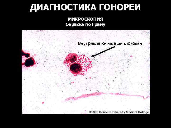ДИАГНОСТИКА ГОНОРЕИ МИКРОСКОПИЯ Окраска по Граму Внутриклеточные диплококки 