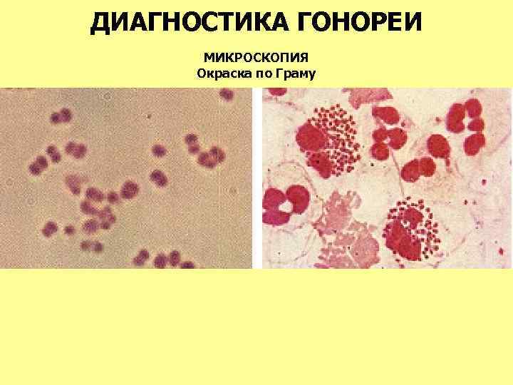 ДИАГНОСТИКА ГОНОРЕИ МИКРОСКОПИЯ Окраска по Граму 