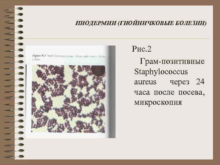 ПИОДЕРМИИ (ГНОЙНИЧКОВЫЕ БОЛЕЗНИ) Рис. 2 Грам-позитивные Staphylococcus aureus через 24 часа после посева, микроскопия