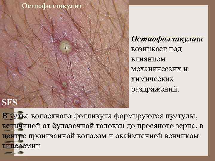 Остиофолликулит возникает под влиянием механических и химических раздражений. В устье волосяного фолликула формируются пустулы,