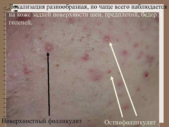 Локализация разнообразная, но чаще всего наблюдается на коже задней поверхности шеи, предплечий, бедер и