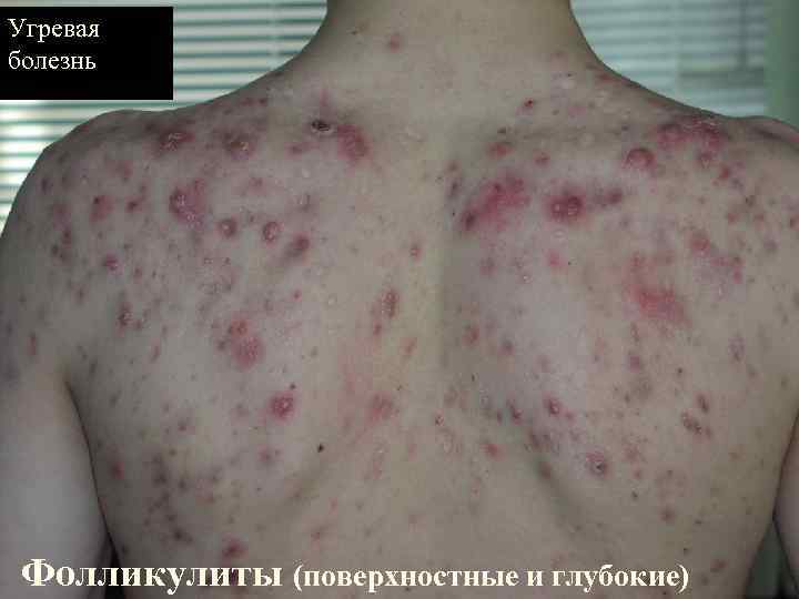 Угревая болезнь Фолликулиты (поверхностные и глубокие) 