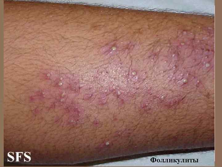 Фолликулиты 