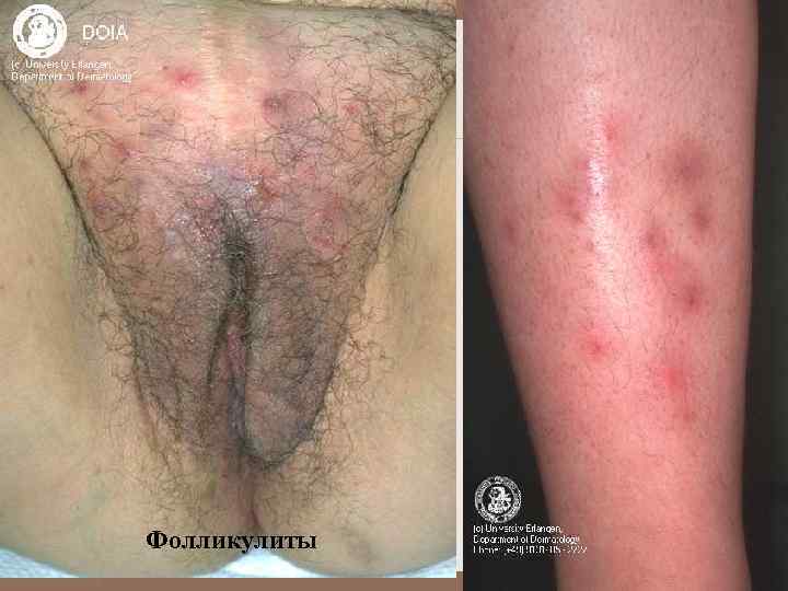 Фолликулиты 