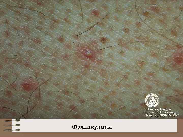 Фолликулиты 