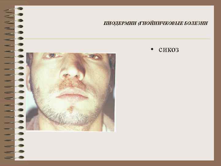 ПИОДЕРМИИ (ГНОЙНИЧКОВЫЕ БОЛЕЗНИ • сикоз 