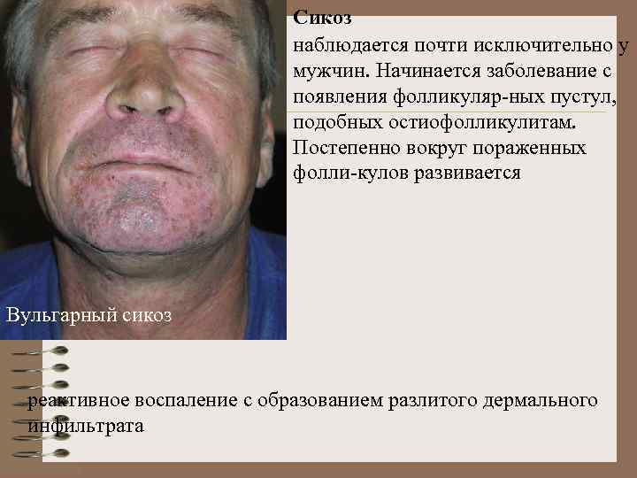 Сикоз наблюдается почти исключительно у мужчин. Начинается заболевание с появления фолликуляр-ных пустул, подобных остиофолликулитам.