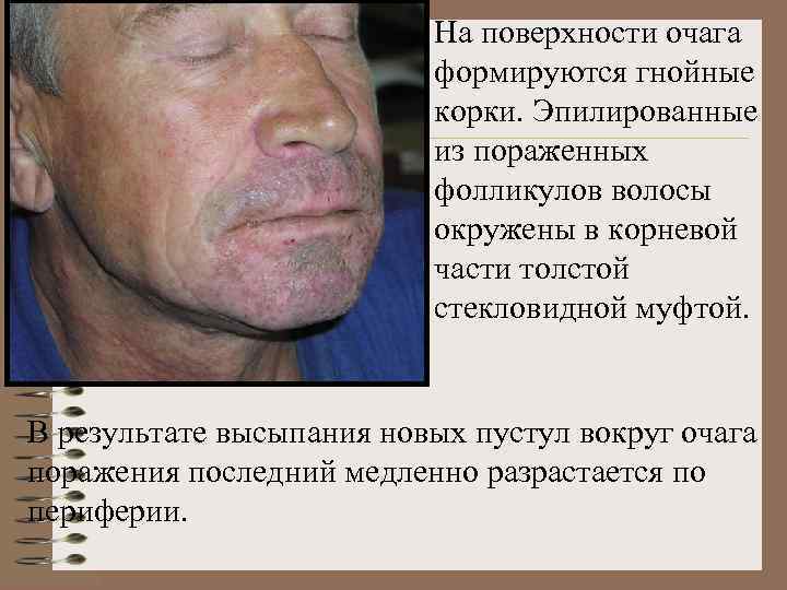 На поверхности очага формируются гнойные корки. Эпилированные из пораженных фолликулов волосы окружены в корневой