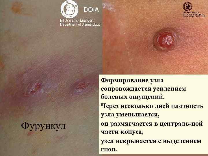 Фурункул Формирование узла сопровождается усилением болевых ощущений. Через несколько дней плотность узла уменьшается, он