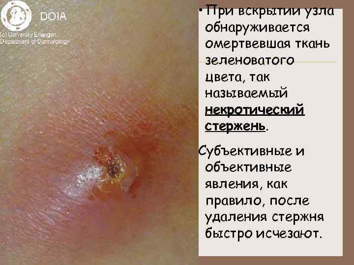  • При вскрытии узла обнаруживается омертвевшая ткань зеленоватого цвета, так называемый некротический стержень.