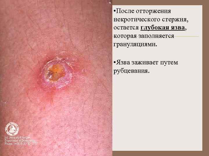  • После отторжения некротического стержня, остается глубокая язва, которая заполняется грануляциями. • Язва
