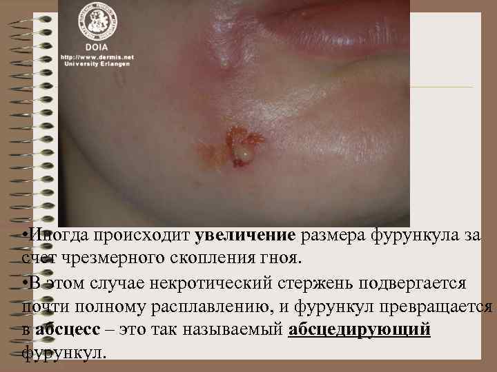  • Иногда происходит увеличение размера фурункула за счет чрезмерного скопления гноя. • В
