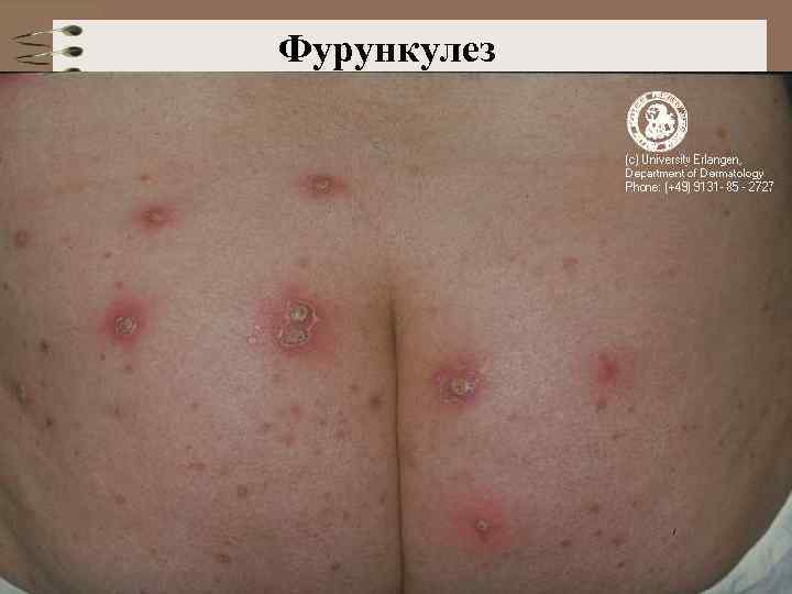 Фурункулез 