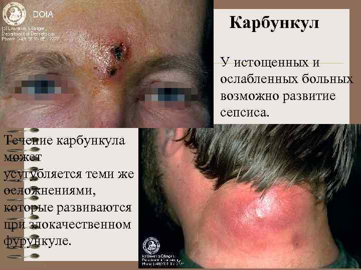 Карбункул У истощенных и ослабленных больных возможно развитие сепсиса. Течение карбункула может усугубляется теми