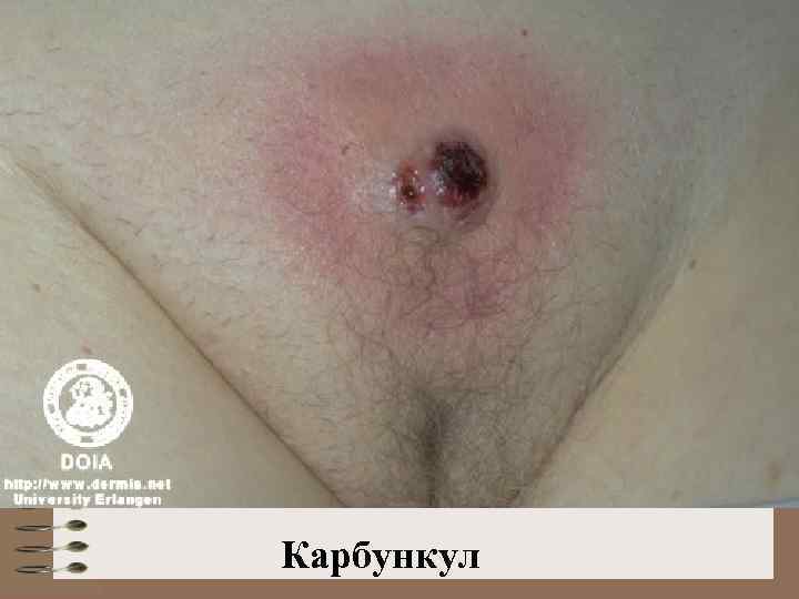 Карбункул 