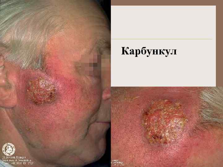 Карбункул 