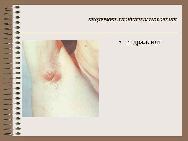 ПИОДЕРМИИ (ГНОЙНИЧКОВЫЕ БОЛЕЗНИ • гидраденит 