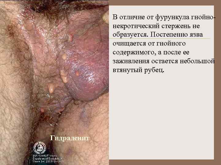 В отличие от фурункула гнойнонекротический стержень не образуется. Постепенно язва очищается от гнойного содержимого,