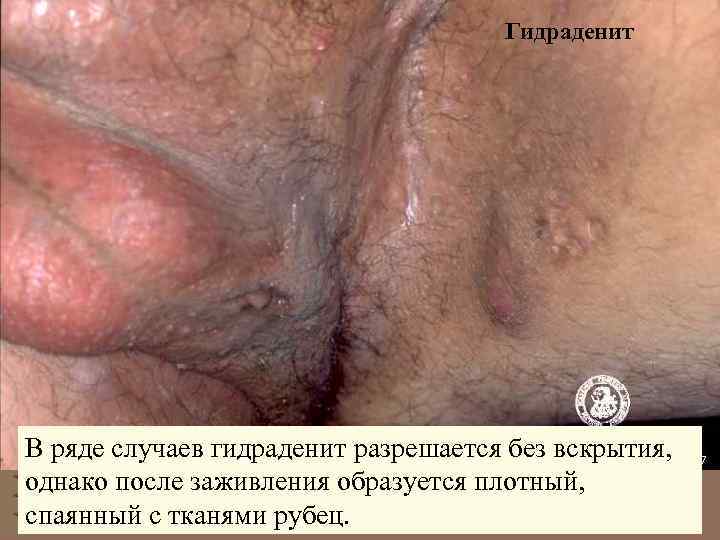 Гидраденит В ряде случаев гидраденит разрешается без вскрытия, однако после заживления образуется плотный, спаянный