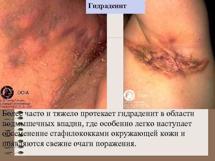 Гидраденит Более часто и тяжело протекает гидраденит в области подмышечных впадин, где особенно легко