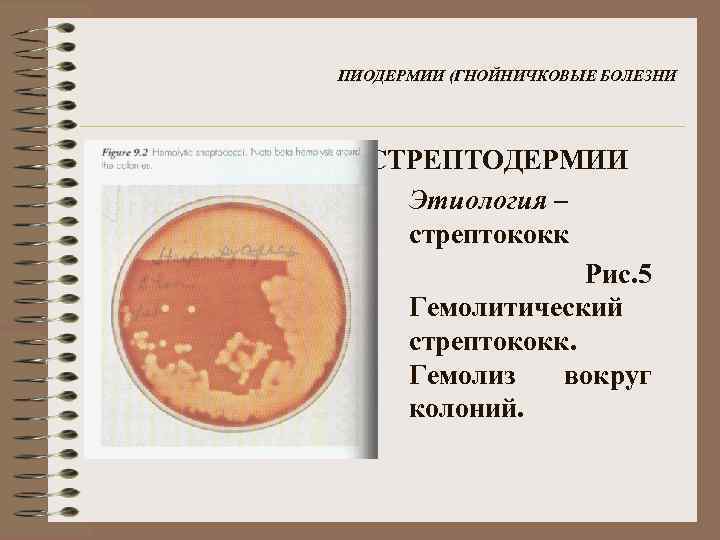 ПИОДЕРМИИ (ГНОЙНИЧКОВЫЕ БОЛЕЗНИ СТРЕПТОДЕРМИИ • Этиология – стрептококк Рис. 5 Гемолитический стрептококк. Гемолиз вокруг
