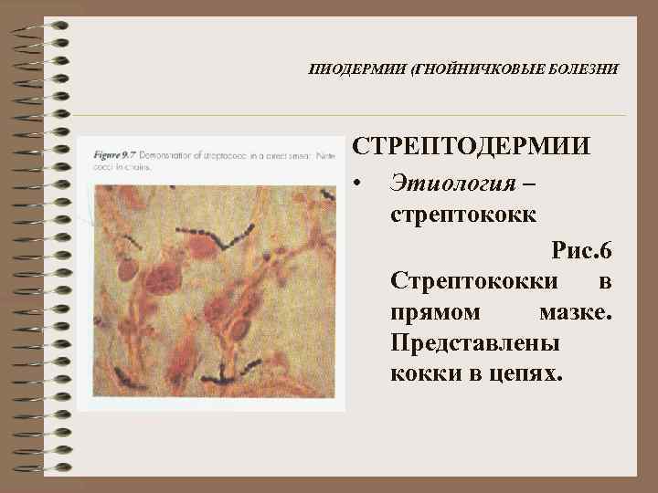 ПИОДЕРМИИ (ГНОЙНИЧКОВЫЕ БОЛЕЗНИ СТРЕПТОДЕРМИИ • Этиология – стрептококк Рис. 6 Стрептококки в прямом мазке.