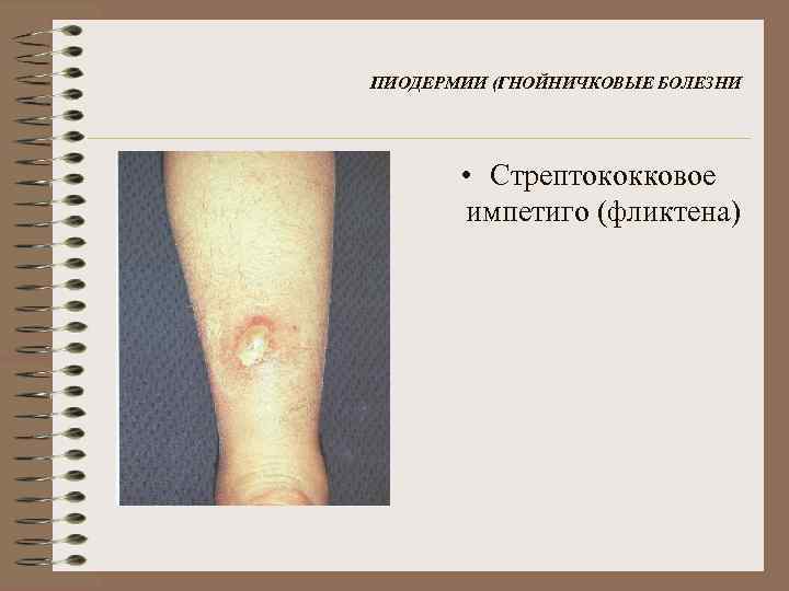 ПИОДЕРМИИ (ГНОЙНИЧКОВЫЕ БОЛЕЗНИ • Стрептококковое импетиго (фликтена) 
