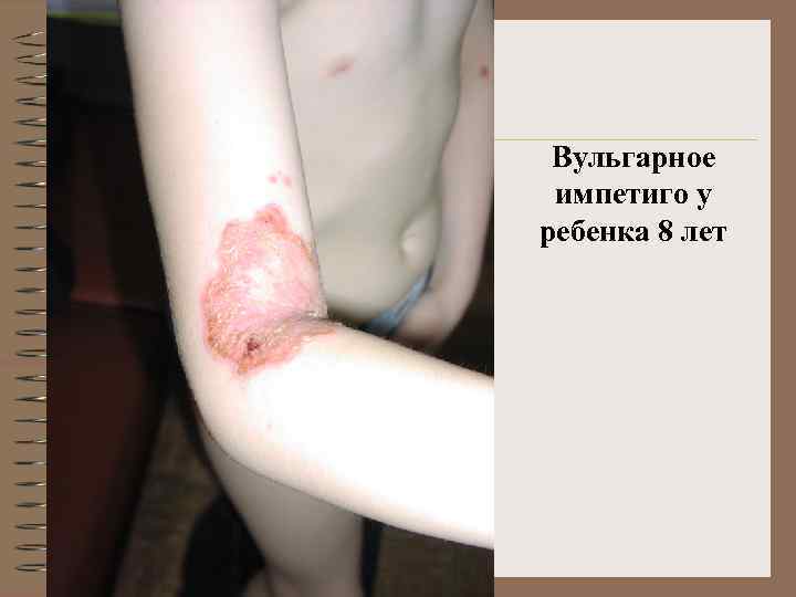 Вульгарное импетиго у ребенка 8 лет 