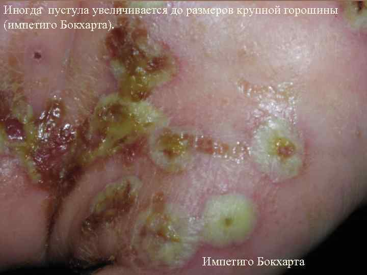 Иногда пустула увеличивается до размеров крупной горошины (импетиго Бокхарта). Импетиго Бокхарта 