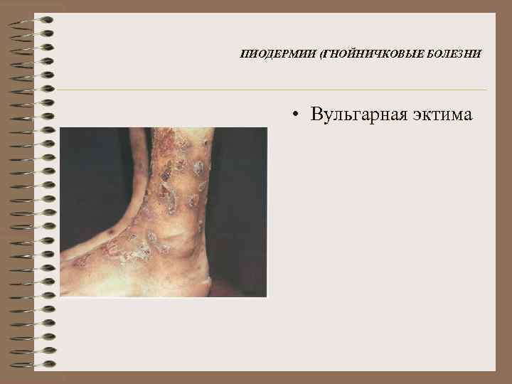 ПИОДЕРМИИ (ГНОЙНИЧКОВЫЕ БОЛЕЗНИ • Вульгарная эктима 