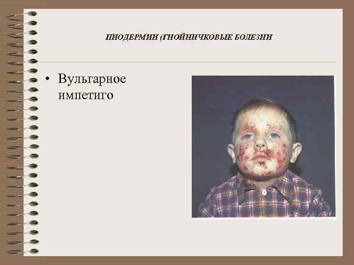ПИОДЕРМИИ (ГНОЙНИЧКОВЫЕ БОЛЕЗНИ • Вульгарное импетиго 