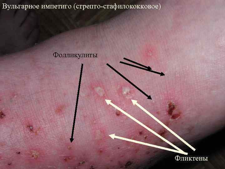 Вульгарное импетиго (стрепто-стафилококковое) Фолликулиты Фликтены 