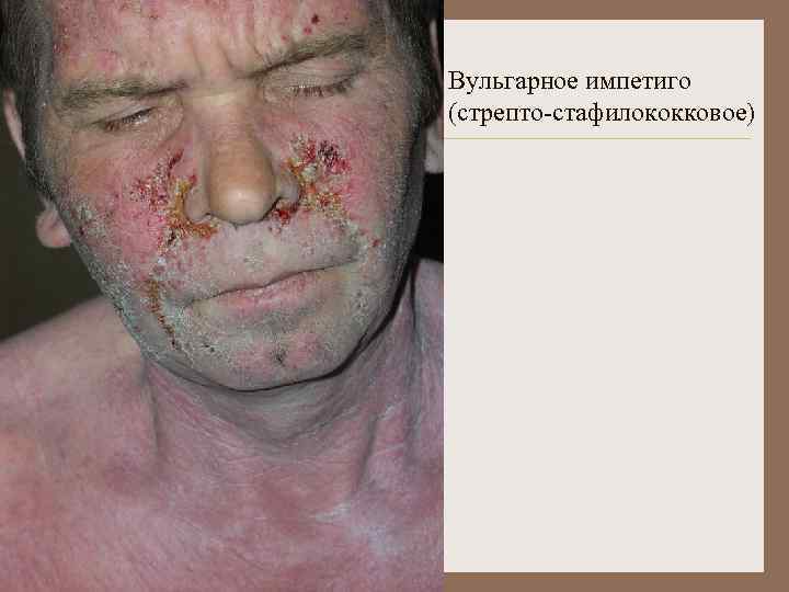 Вульгарное импетиго (стрепто-стафилококковое) 