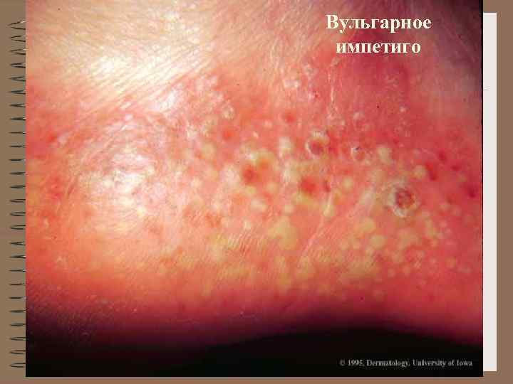 Вульгарное импетиго 