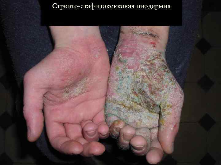 Стрепто-стафилококковая пиодермия 