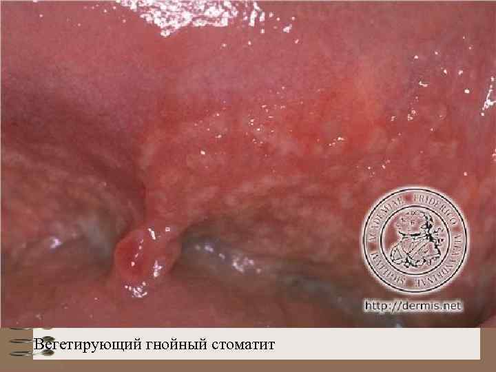 Вегетирующий гнойный стоматит 