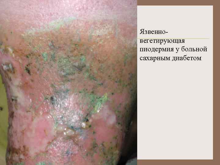 Язвенновегетирующая пиодермия у больной сахарным диабетом 