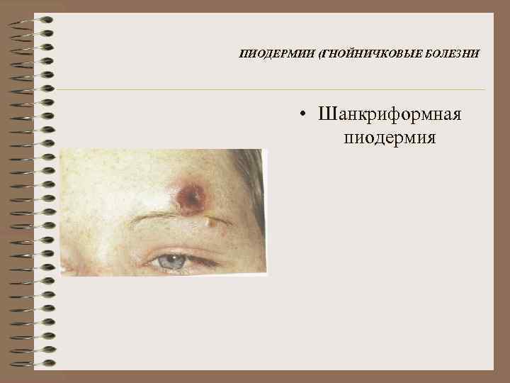 ПИОДЕРМИИ (ГНОЙНИЧКОВЫЕ БОЛЕЗНИ • Шанкриформная пиодермия 