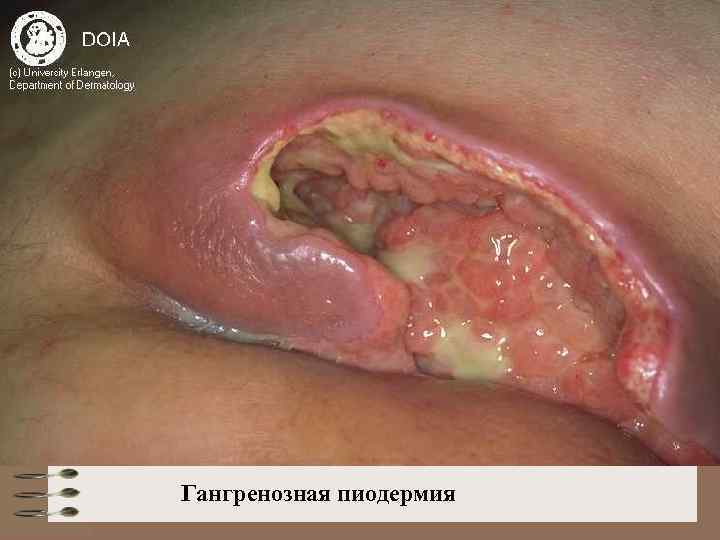 Гангренозная пиодермия 