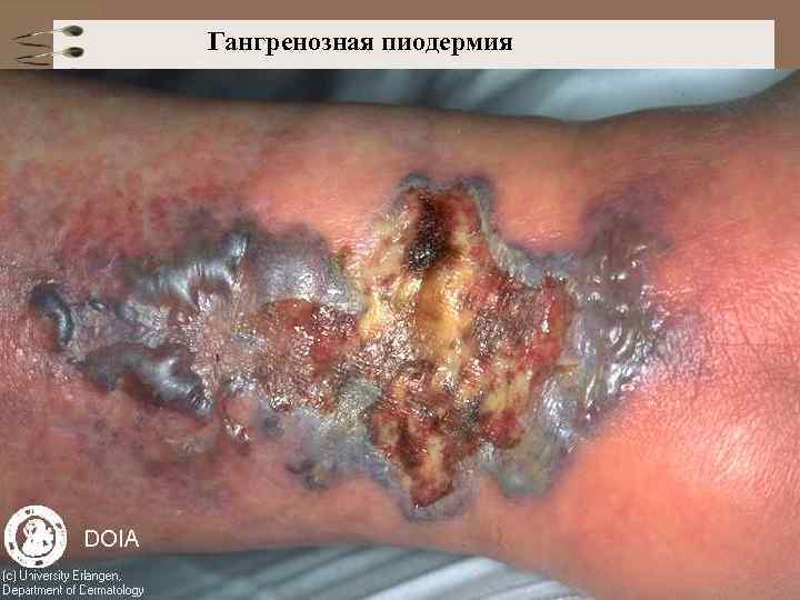 Гангренозная пиодермия 