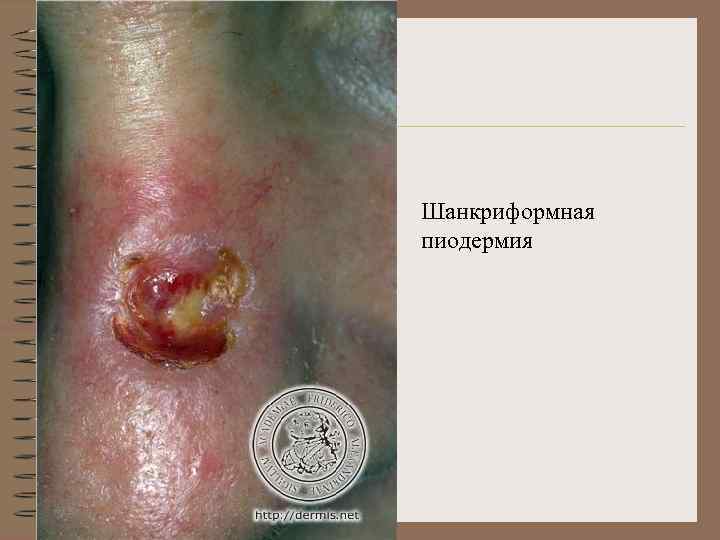 Шанкриформная пиодермия 