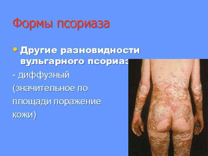 Формы псориаза • Другие разновидности вульгарного псориаза: - диффузный (значительное по площади поражение кожи)