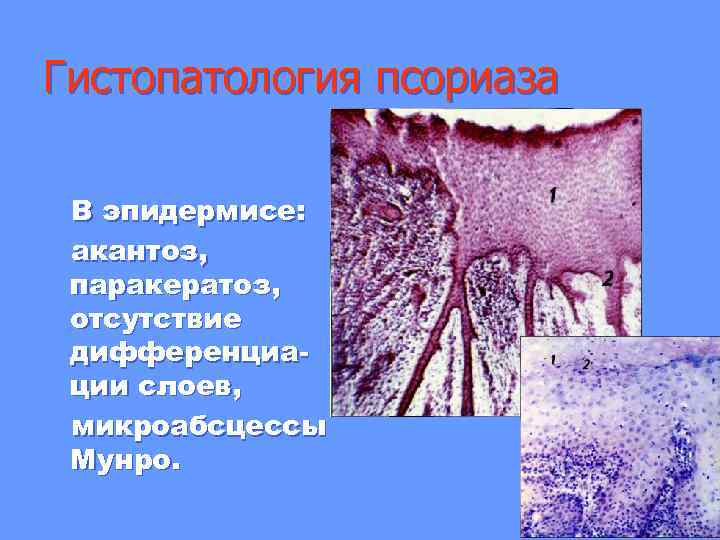 Гистопатология псориаза В эпидермисе: акантоз, паракератоз, отсутствие дифференциации слоев, микроабсцессы Мунро. 