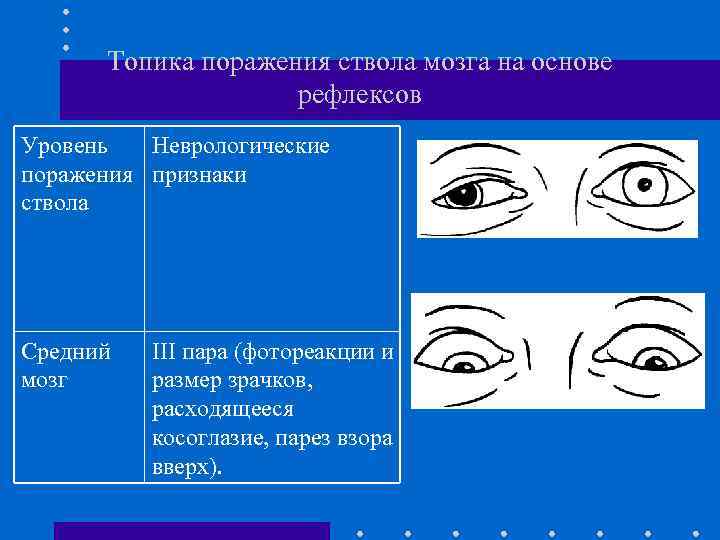 Топика поражения ствола мозга на основе рефлексов Уровень Неврологические поражения признаки ствола Средний мозг