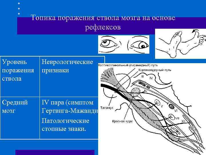 Топика поражения ствола мозга на основе рефлексов Уровень Неврологические поражения признаки ствола Средний мозг