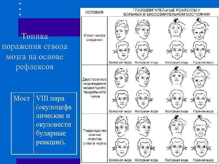 Топика поражения ствола мозга на основе рефлексов Мост VIII пара (окулоцефа лические и окуловести