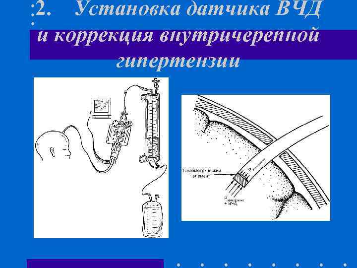2. Установка датчика ВЧД и коррекция внутричерепной гипертензии 