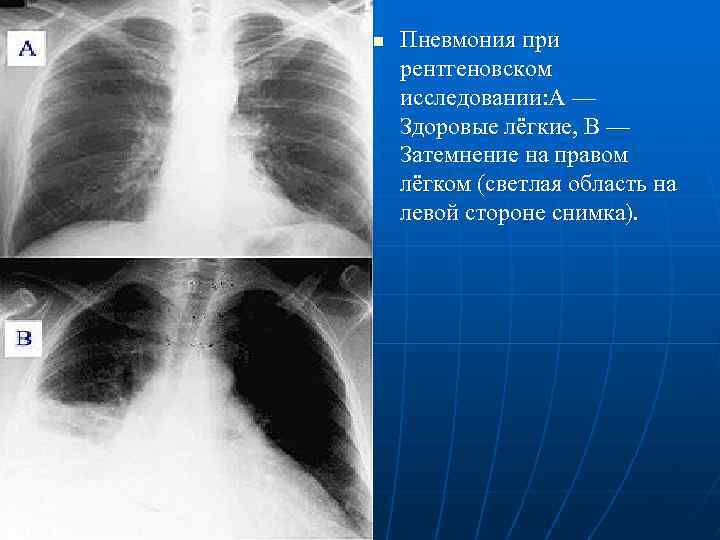n Пневмония при рентгеновском исследовании: А — Здоровые лёгкие, В — Затемнение на правом