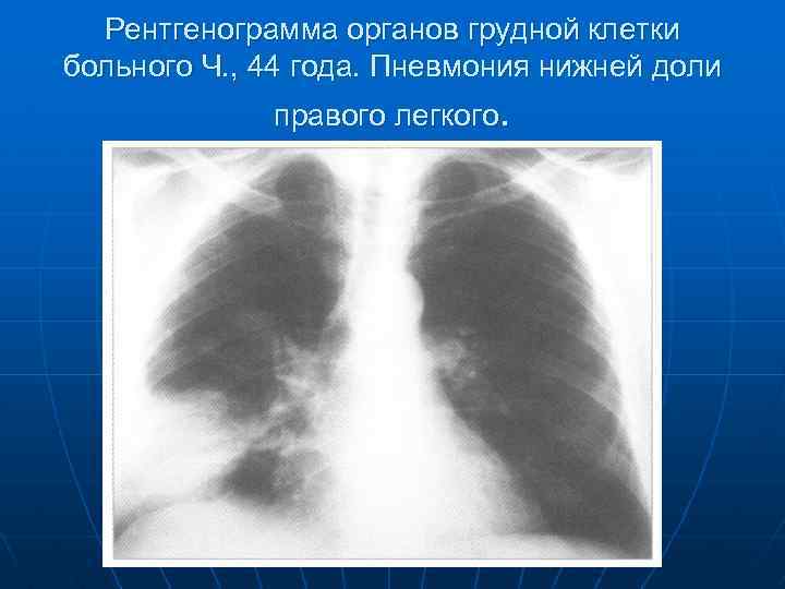 Рентгенограмма органов грудной клетки больного Ч. , 44 года. Пневмония нижней доли правого легкого.