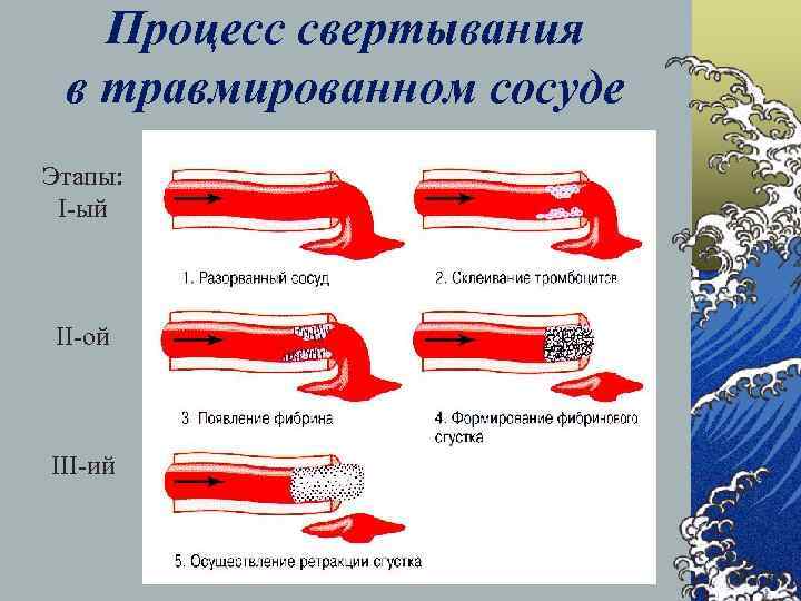 Процесс свертывания в травмированном сосуде Этапы: I-ый II-ой III-ий 